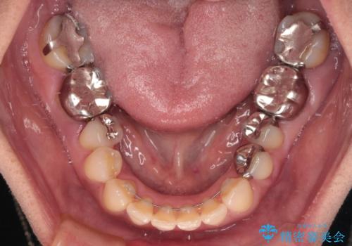 中途半端な矯正治療と前歯の欠損　再矯正とオールセラミッククラウンによる補綴治療の治療後