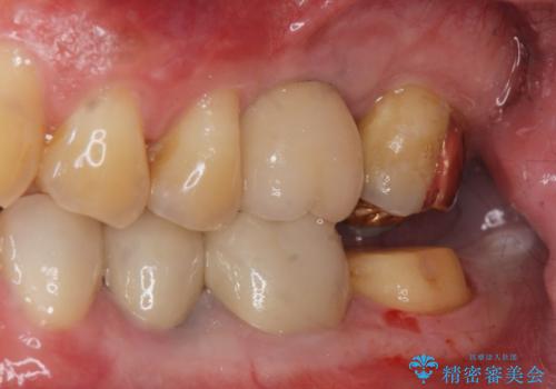 ゴールドクラウンの治療中