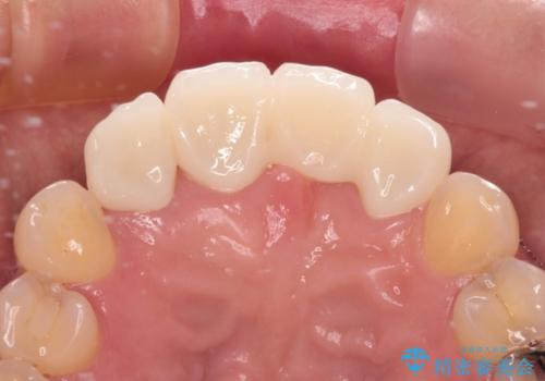 中途半端な矯正治療と前歯の欠損 再矯正とオールセラミッククラウンによる補綴治療の治療後