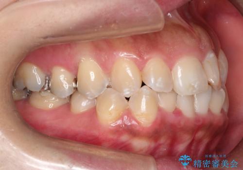 前歯のガタつきをマウスピース矯正で改善! 驚きの効果を体験しようの治療前