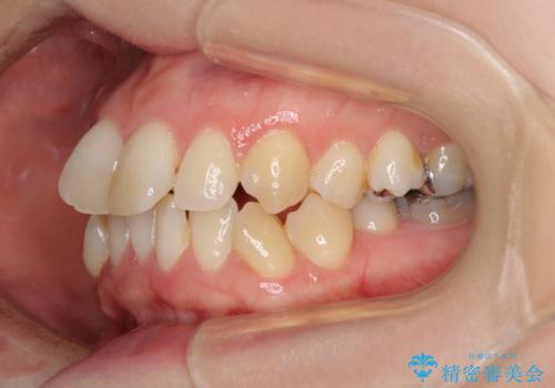大きなむし歯の奥歯を抜歯してスペースを活用　ワイヤー装置による抜歯矯正の治療前