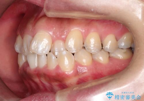 前歯のガタつきをマウスピース矯正で改善!　驚きの効果を体験しようの治療前