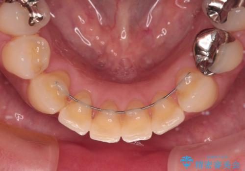 中途半端な矯正治療と前歯の欠損 再矯正とオールセラミッククラウンによる補綴治療の治療後