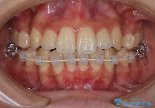 目立たないハーフリンガル矯正 抜歯矯正で口元の突出感を改善の治療中