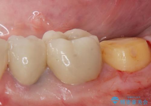 ゴールドクラウンの治療中
