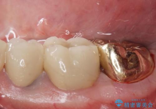 ゴールドクラウンの治療後