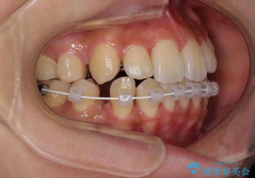 目立たないハーフリンガル矯正 抜歯矯正で口元の突出感を改善の治療中