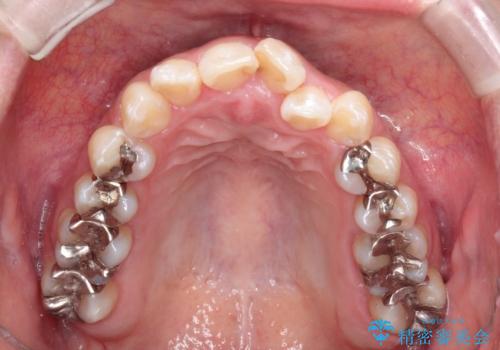 前歯のガタつきをマウスピース矯正で改善! 驚きの効果を体験しようの治療前