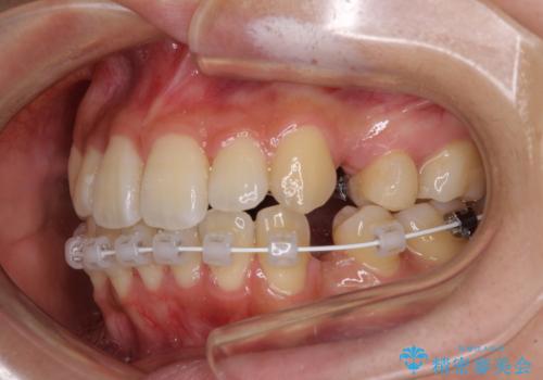目立たないハーフリンガル矯正　抜歯矯正で口元の突出感を改善の治療中