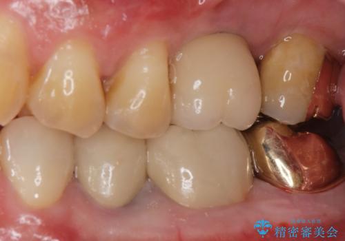 ゴールドクラウンの治療後