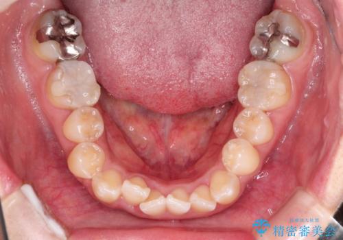 前歯のガタつきをマウスピース矯正で改善! 驚きの効果を体験しようの治療前