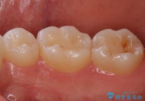奥歯が欠けた セラミックインレーでの修復後、ナイトガード装着の治療前