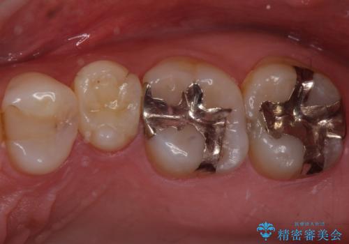 銀歯のやり替え　セラミックインレーでの治療の治療前