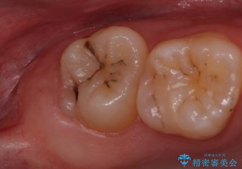 歯の高さを出すための親知らず抜歯と歯肉切除の治療前