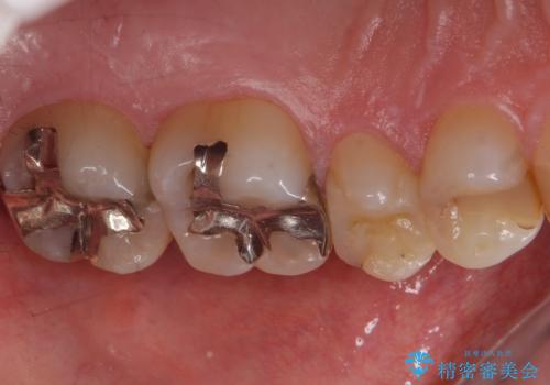 銀歯のやり替え セラミックインレーでの治療の治療前