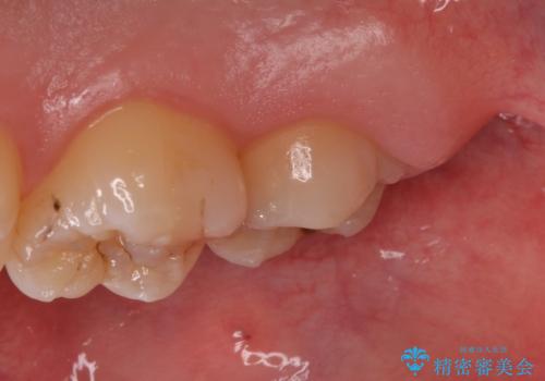 歯の高さを出すための親知らず抜歯と歯肉切除の症例 治療前