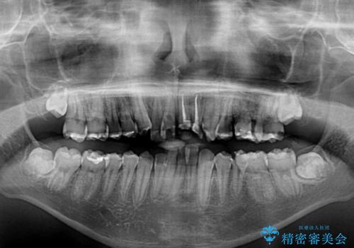 前歯のデコボコとむし歯だらけの歯列 矯正治療と虫歯治療の治療前