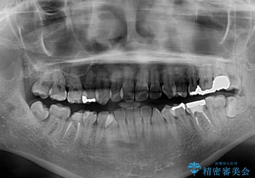 大きなむし歯の奥歯を抜歯してスペースを活用　ワイヤー装置による抜歯矯正の治療前
