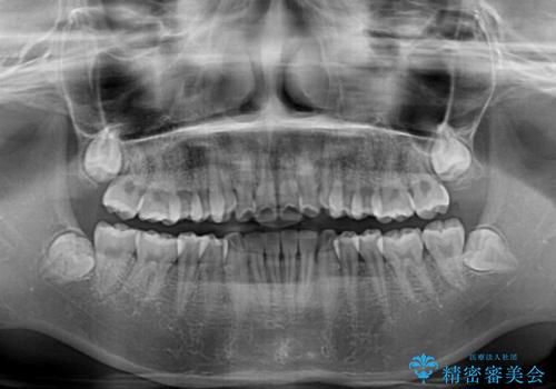 カリエール・ディスタライザーを併用したインビザライン矯正治療の治療前