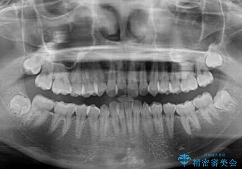 前歯のデコボコと隠れてしまう下顎前歯　インビザラインですっきりと改善の治療前
