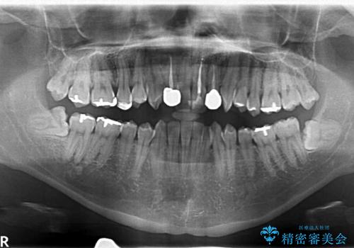 リラックス麻酔下で行う親知らず抜歯の治療前