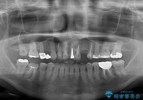 欠損やむし歯の歯をきれいなセラミックに 全顎虫歯治療の治療前