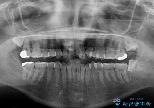 前歯のクロスバイトを改善 ワイヤー矯正を併用したインビザライン矯正の治療前
