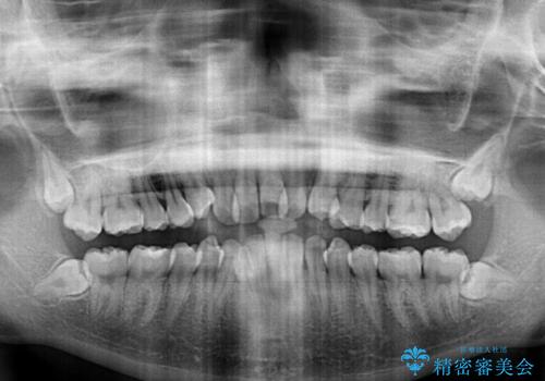 目立たないハーフリンガル矯正 抜歯矯正で口元の突出感を改善の治療前