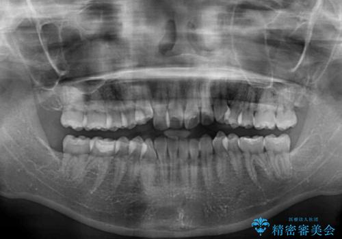 前歯のデコボコを楽して改善 ワイヤー装置による矯正治療の治療前