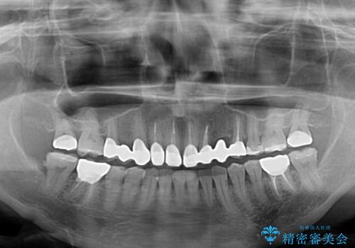 欠損やむし歯の歯をきれいなセラミックに　全顎虫歯治療の治療後