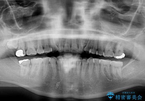 前歯のクロスバイトを改善 ワイヤー矯正を併用したインビザライン矯正の治療後