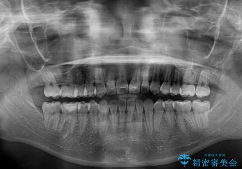 前歯のデコボコを楽して改善 ワイヤー装置による矯正治療の治療後