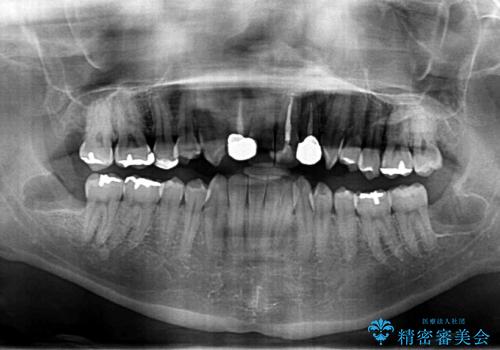 リラックス麻酔下で行う親知らず抜歯の治療後