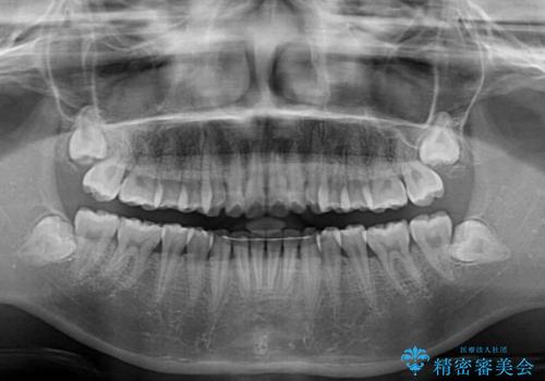 カリエール・ディスタライザーを併用したインビザライン矯正治療の治療後