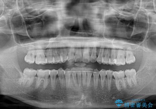 前歯のデコボコと隠れてしまう下顎前歯 インビザラインですっきりと改善の治療後