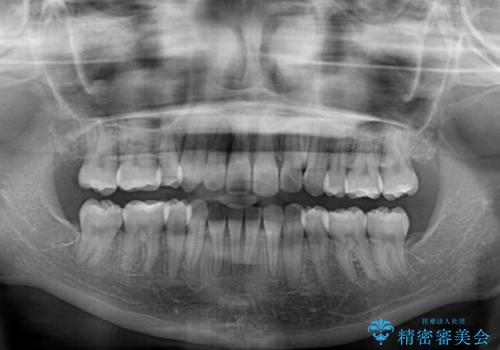 目立たないハーフリンガル矯正　抜歯矯正で口元の突出感を改善の治療後