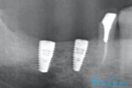 歯周病により抜去した歯のインプラント治療の治療中