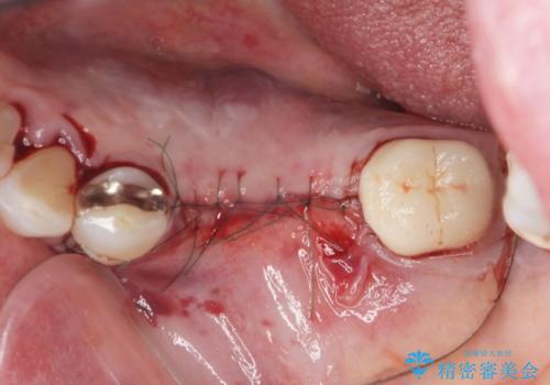 下顎骨隆起を用いた骨造成・インプラント補綴の治療中