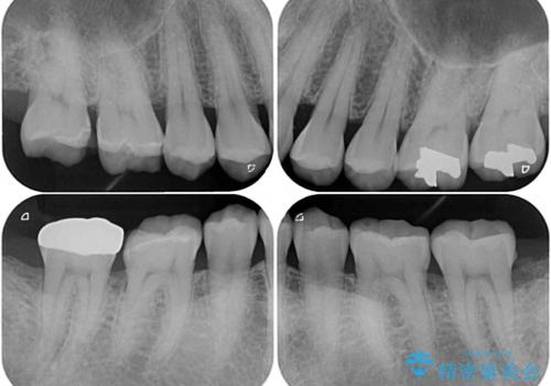 歯肉が腫れて出血する奥歯 歯周外科処置を用いたセラミック補綴治療の治療前