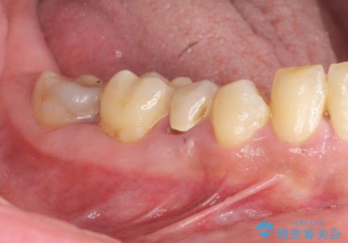 歯周病により抜去した歯のインプラント治療の治療前