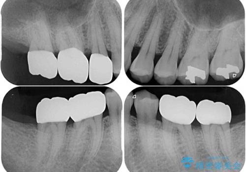 歯肉が腫れて出血する奥歯 歯周外科処置を用いたセラミック補綴治療の治療後