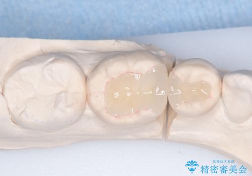 【ハイブリッドインレー】銀歯を白くしたい