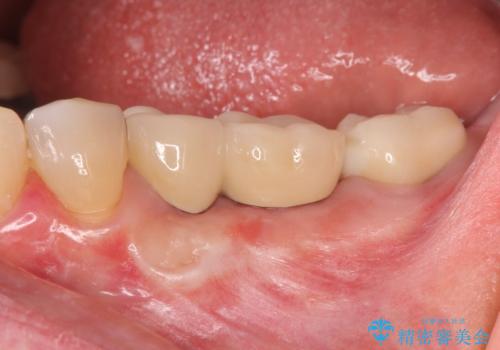 下顎骨隆起を用いた骨造成・インプラント補綴の症例 治療後