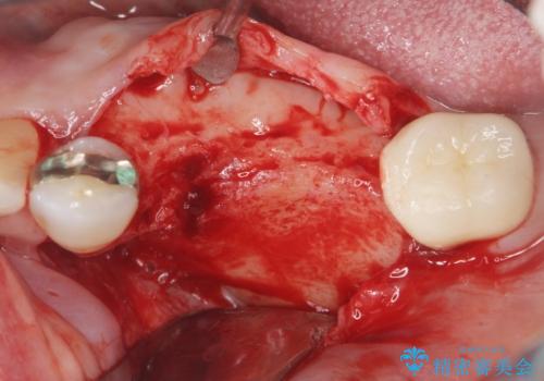 下顎骨隆起を用いた骨造成・インプラント補綴の治療中
