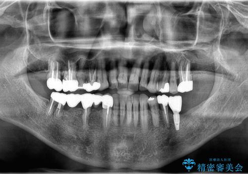 【インプラント】銀歯が取れて歯ごと折れたの治療後