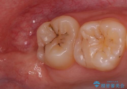 歯の高さを出すための親知らず抜歯と歯肉切除の治療後