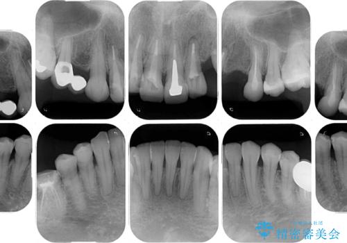欠損やむし歯の歯をきれいなセラミックに 全顎虫歯治療の治療前