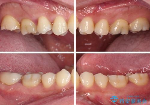 歯肉が腫れて出血する奥歯 歯周外科処置を用いたセラミック補綴治療の治療前