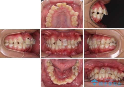 前歯のデコボコとむし歯だらけの歯列　矯正治療と虫歯治療の治療前