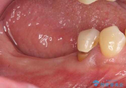 歯周病により抜去した歯のインプラント治療の治療中